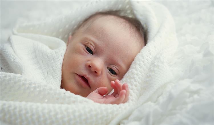 اعراض متلازمة داون عند الاطفال حديثي الولادة