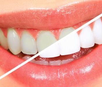 نصائح للتخلص من اصفرار الأسنان وخلطات طبيعية مجربة