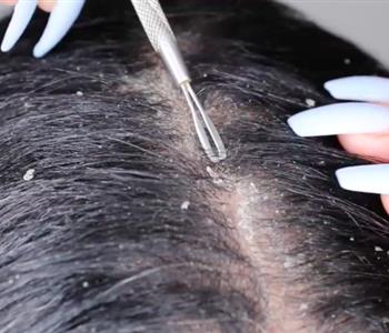 12 وصفة طبيعية للقضاء على قشرة الشعر نهائي ا