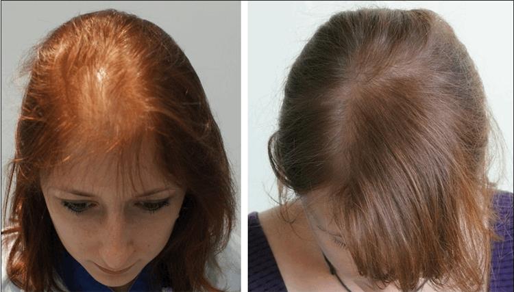 عملية زراعة الشعر الطبيعي