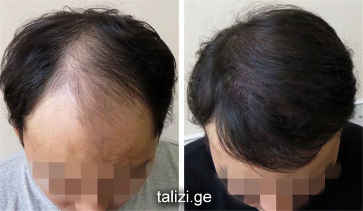 تقنيات عملية زراعة الشعر الطبيعي