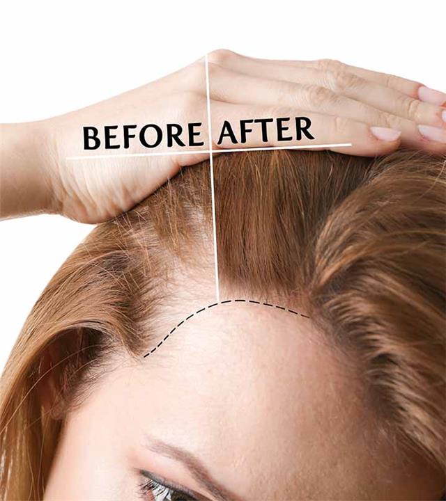 تكلفة عملية زراعة الشعر الطبيعي