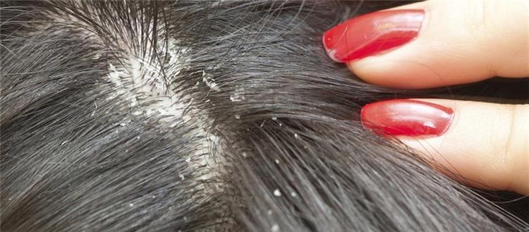 وصفات طبيعية للقضاء على قشرة الشعر