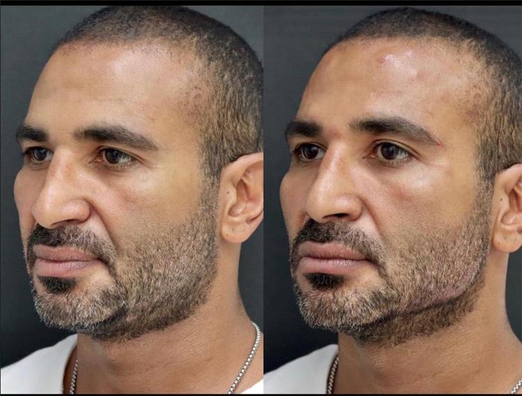 أحمد سعد يخضع لعملية تجميل في الوجه