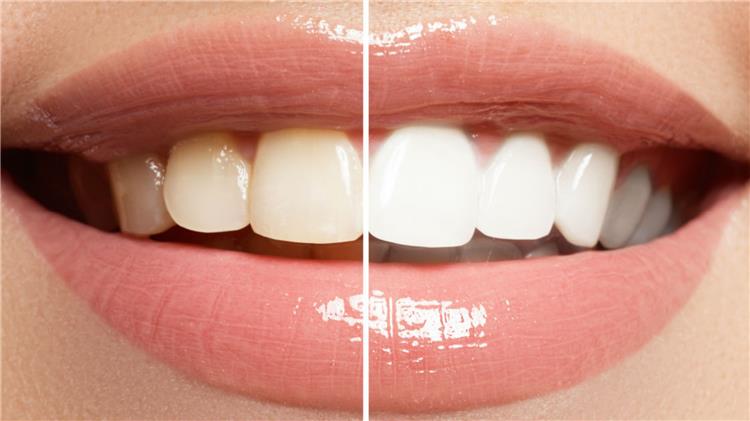 كيف تحصلي على أسنان بيضاء بدون الذهاب للطبيب؟