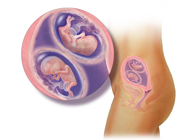 أعراض الحمل بتوأم