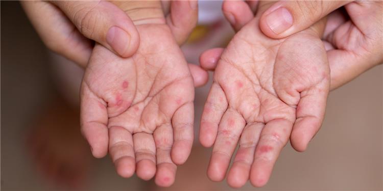 أعراض فيروس HFMD وكيفية تشخيصه عند الأطفال والبالغين