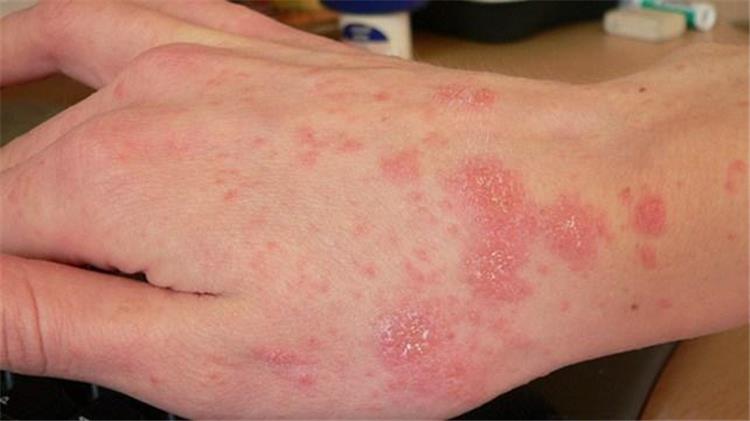 طرق فعالة لعلاج الجرب