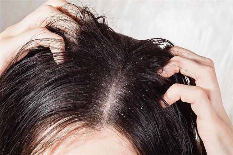 وصفة طبيعية للتخلص من قشرة الشعر نهائيًا