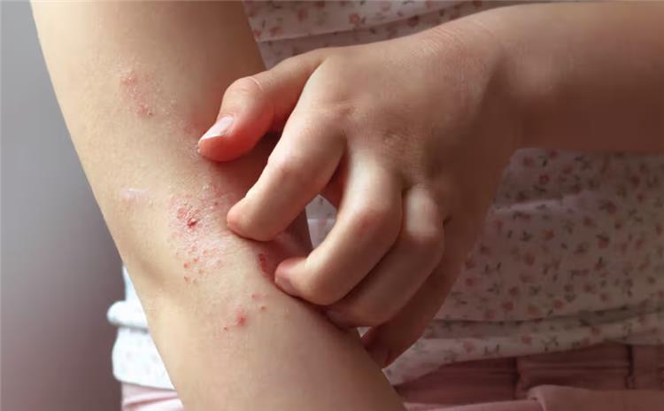 طرق الوقاية من الأمراض الجلدية والطفيليات بين الأطفال