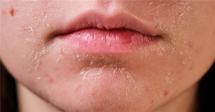 أسباب جفاف الجلد حول الفم وكيفية علاجه
