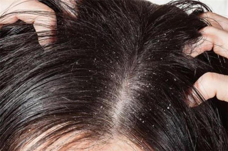 علاج قشرة الشعر الدهني بخلطات طبيعية مجربة لهلوبة