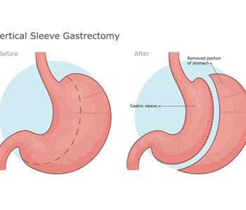 أقل وزن لعملية تكميم المعدة لا داعي للاستسهال