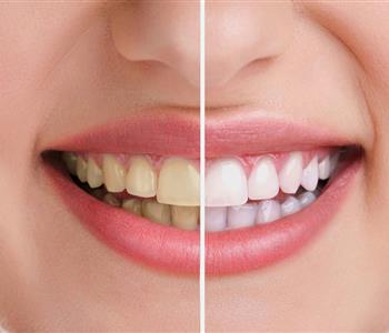 تبييض الأسنان بالليزر الفوائد والأضرار