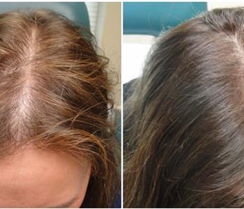 علاج الشعر الخفيف بوصفات طبيعية مجربة