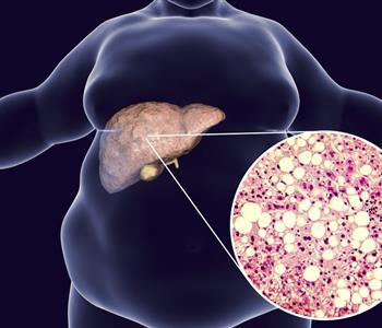 كيفية التخلص من الدهون المتراكمة على الكبد