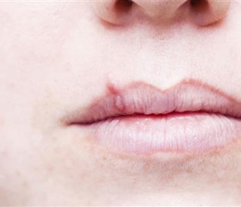 3 مكونات طبيعية لعلاج الحبوب حول الفم