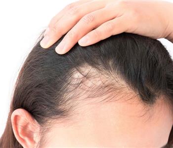 4 وصفات طبيعية لعلاج تساقط الشعر من الأمام