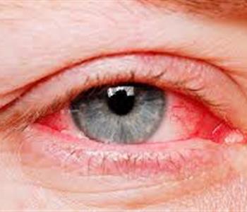 اضرار الكلور المثبتة علميا على العين