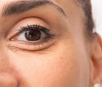 طرق طبيعية لمكافحة تجاعيد العين بدون استخدام البوتوكس