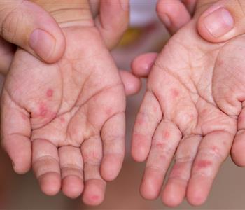 أعراض فيروس HFMD وكيفية تشخيصه عند الأطفال والبالغين