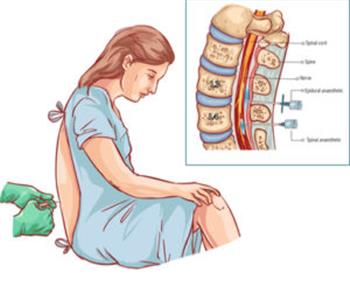 ماذا يحدث لجسمك بعد حقنة الأبيديورال لولادة بدون ألم