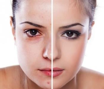 علاج طبيعي لبقع الوجه الداكنة 7 وصفات سهلة