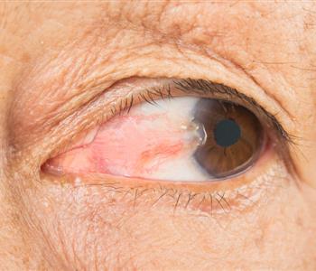 أضرار الأشعة فوق البنفسجية على العين