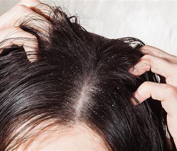 وصفة طبيعية للتخلص من قشرة الشعر نهائي ا