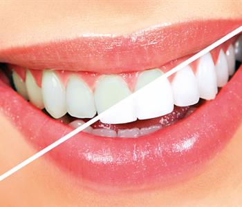فوائد واضرار الكركم على الاسنان