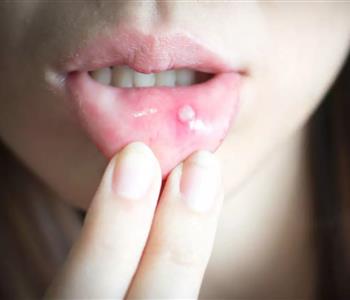 علاجات منزلية للتخلص من قرحة الفم