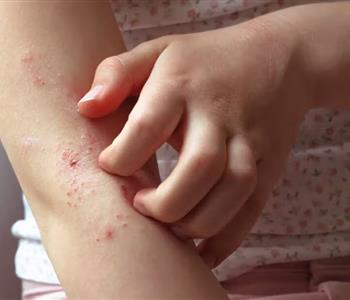 طرق الوقاية من الأمراض الجلدية والطفيليات بين الأطفال