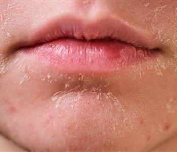 أسباب جفاف الجلد حول الفم وكيفية علاجه