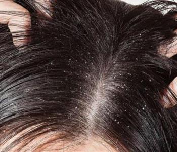علاج قشرة الشعر الدهني بخلطات طبيعية مجربة