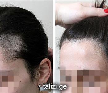 اضرار زراعة الشعر الطبيعي