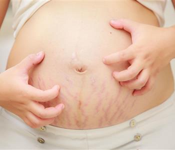 أسباب الحكة أثناء الحمل وطرق علاجها