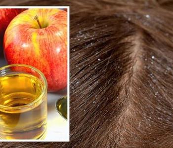 فوائد خل التفاح لتنظيف الشعر الدهني يكافح القشرة