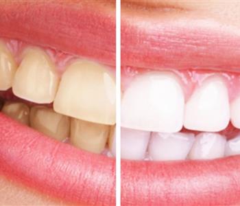 15 وصفة طبيعية لتبييض الأسنان في وقت قياسي